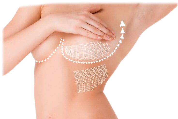 Mammax capsule action for breast augmentation