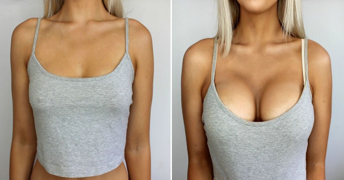 Before and after breast enlargement