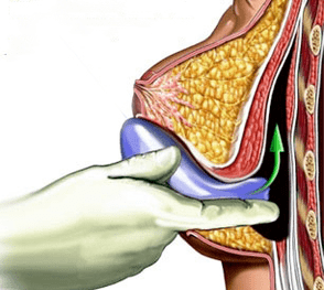 Implantation for breast augmentation