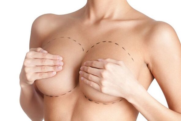 markup for breast augmentation surgery