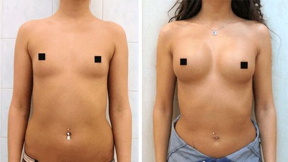 pictures before and after breast surgery increased