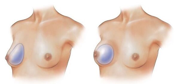 round and round shaped implants for breast augmentation