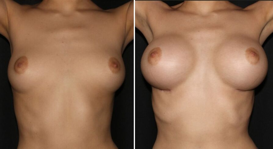 Before and after breast augmentation surgery