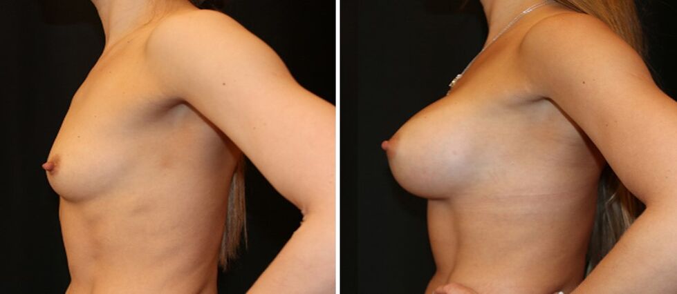Breasts before and after enlargement